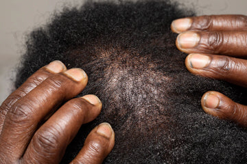 Effective Conditioners for Thinning Hair Care