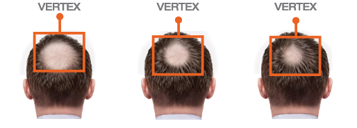 FOLIGAIN Minoxidil 5% Hair Regrowth Foam For Men 3 Month Supply - FOLIGAIN NEW ZEALAND