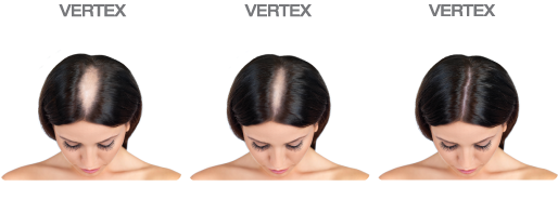 FOLIGAIN Women's Hair Regrowth Kit