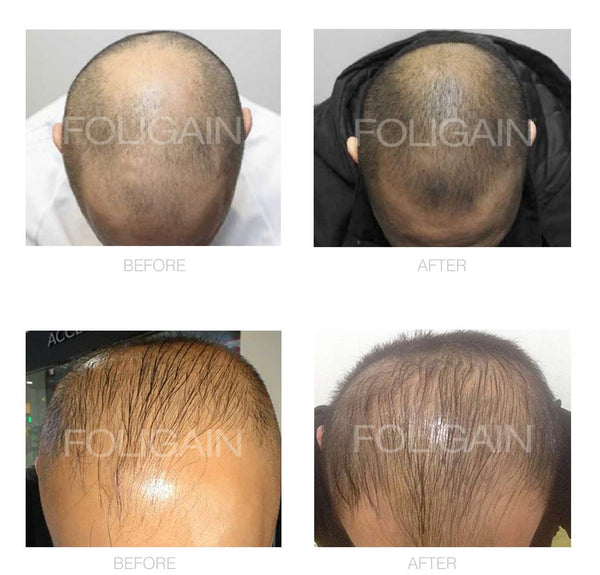 FOLIGAIN Low Alcohol Minoxidil 5% Hair Regrowth Treatment For Men 12 Month Supply - FOLIGAIN NEW ZEALAND