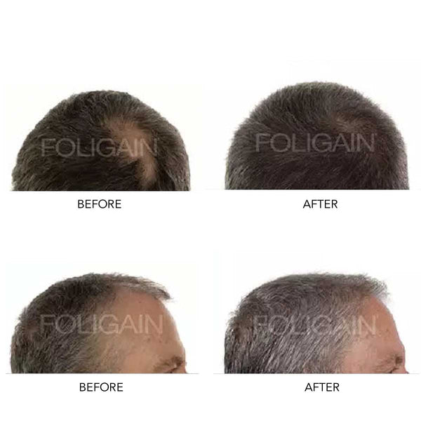 FOLIGAIN Men's Hair Regrowth Kit - FOLIGAIN NEW ZEALAND