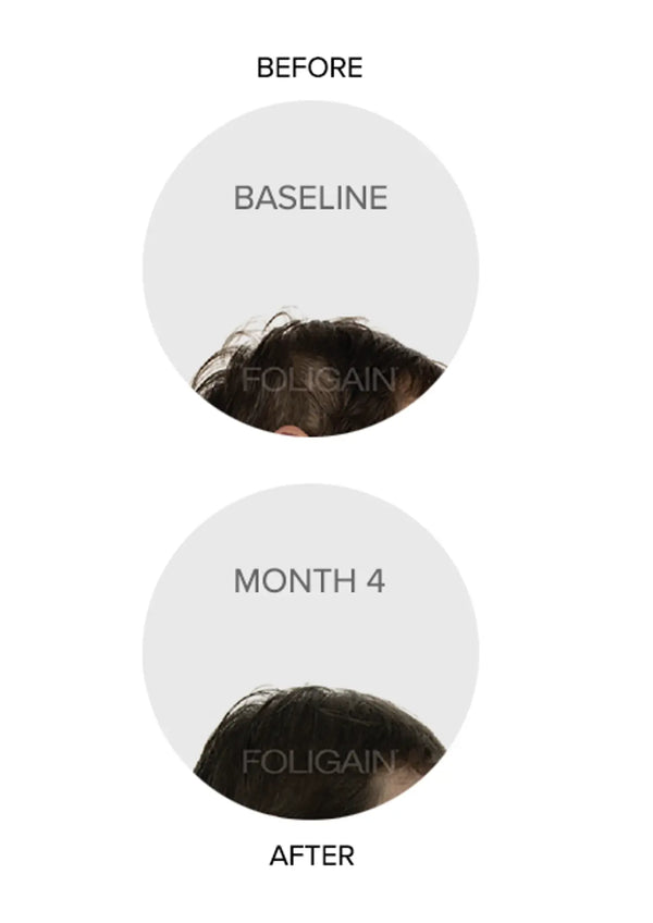 FOLIGAIN Triple Action Complete Formula For Thinning Hair For Women with 10% Trioxidil - FOLIGAIN NEW ZEALAND