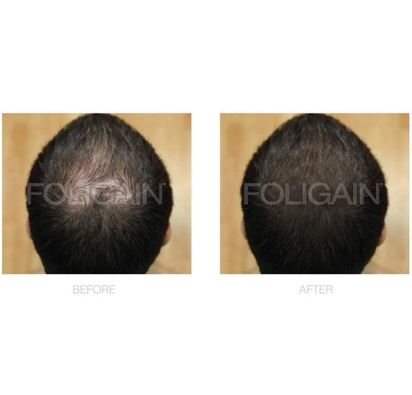 FOLIGAIN Minoxidil 5% Hair Regrowth Foam For Men 3 Month Supply - FOLIGAIN NEW ZEALAND