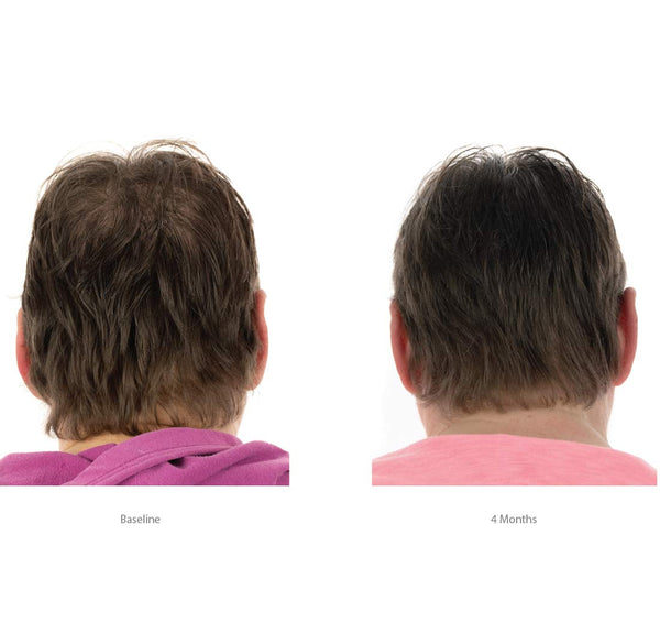 FOLIGAIN Women's Hair Regrowth Kit - FOLIGAIN NEW ZEALAND