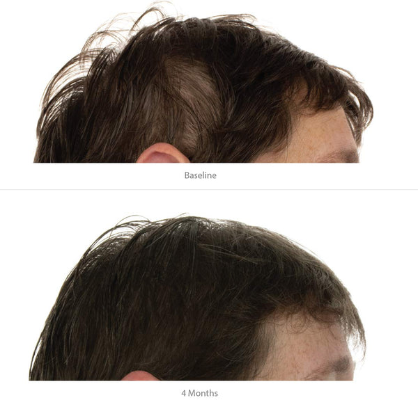 FOLIGAIN Women's Hair Regrowth Kit - FOLIGAIN NEW ZEALAND