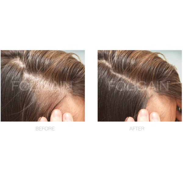 FOLIGAIN Minoxidil 2% Hair Regrowth Treatment For Women 6 Month Supply - FOLIGAIN NEW ZEALAND
