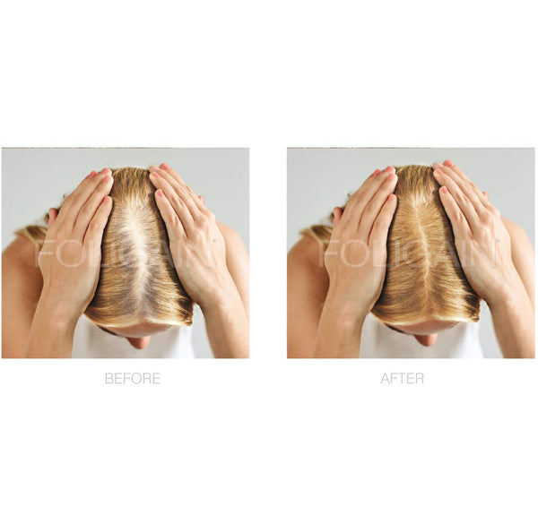 FOLIGAIN Minoxidil 2% Hair Regrowth Treatment For Women 12 Month Supply